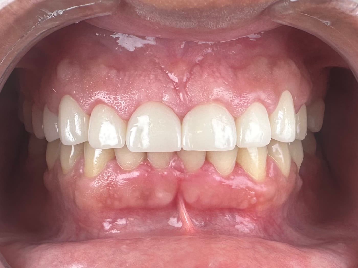 Case 02, after treatment