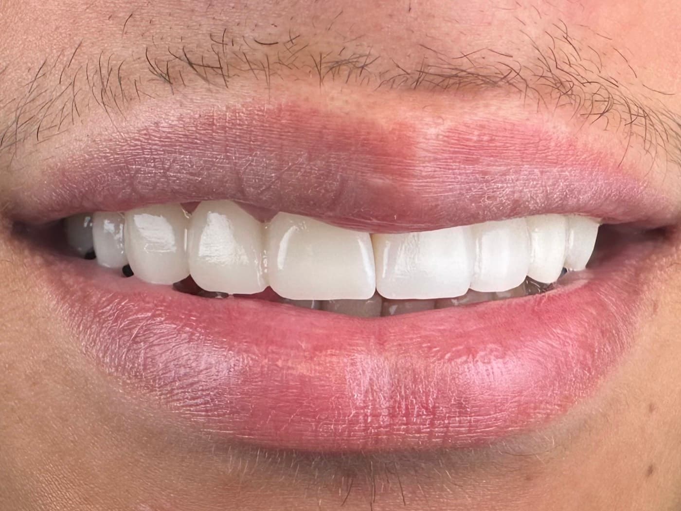 Case 03, after treatment