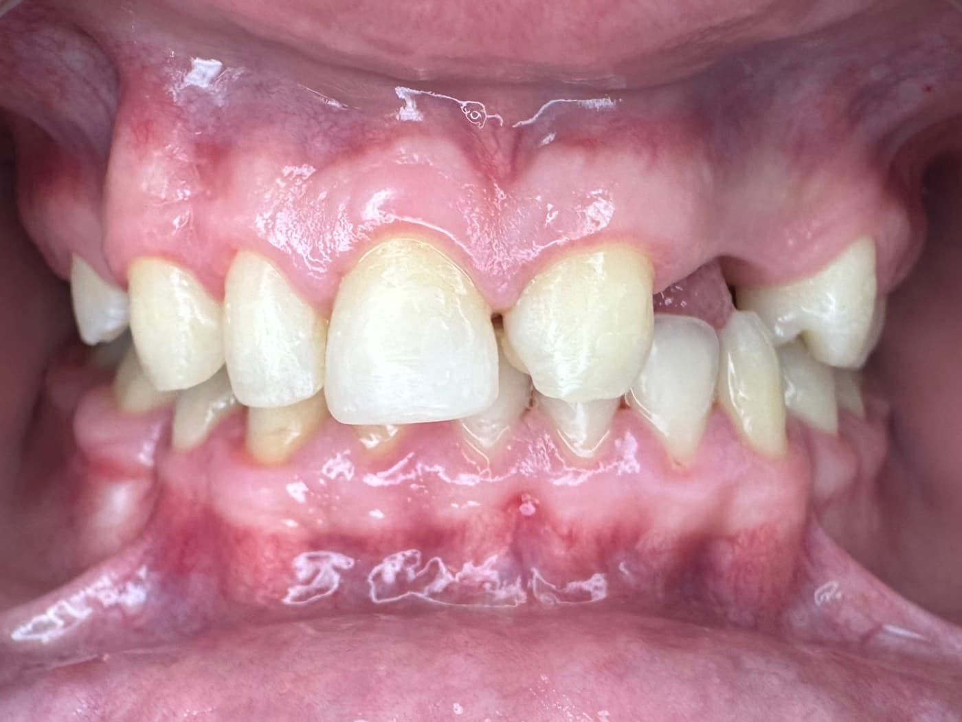 Case 03, before treatment