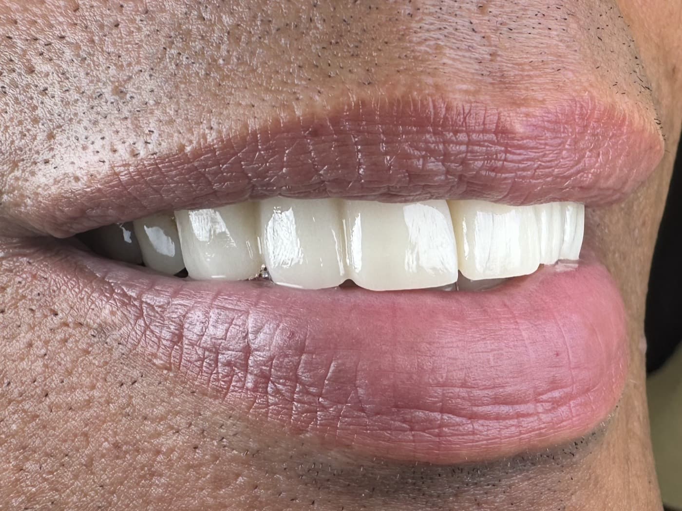Case 04, after treatment