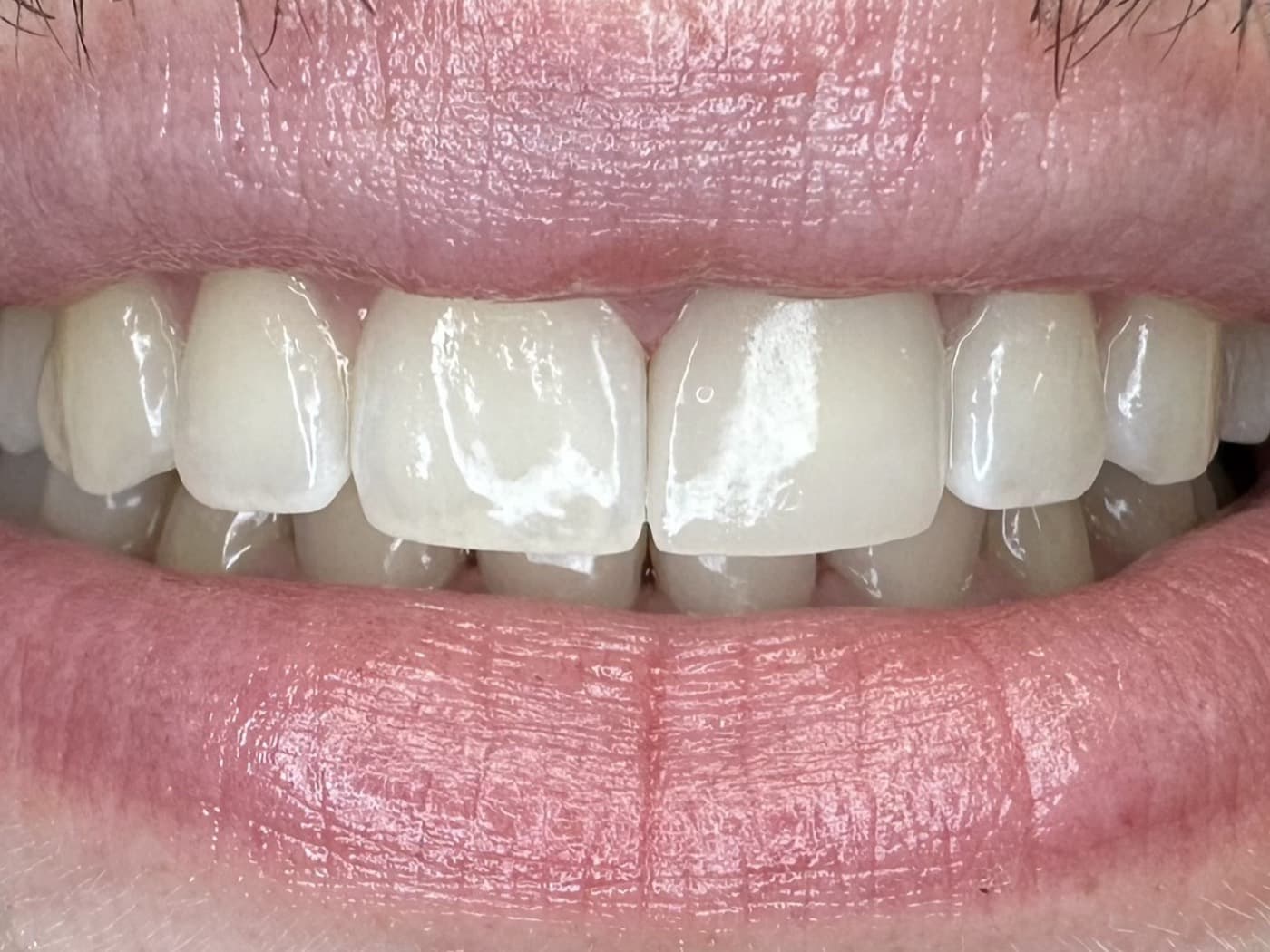 Case 05, after treatment