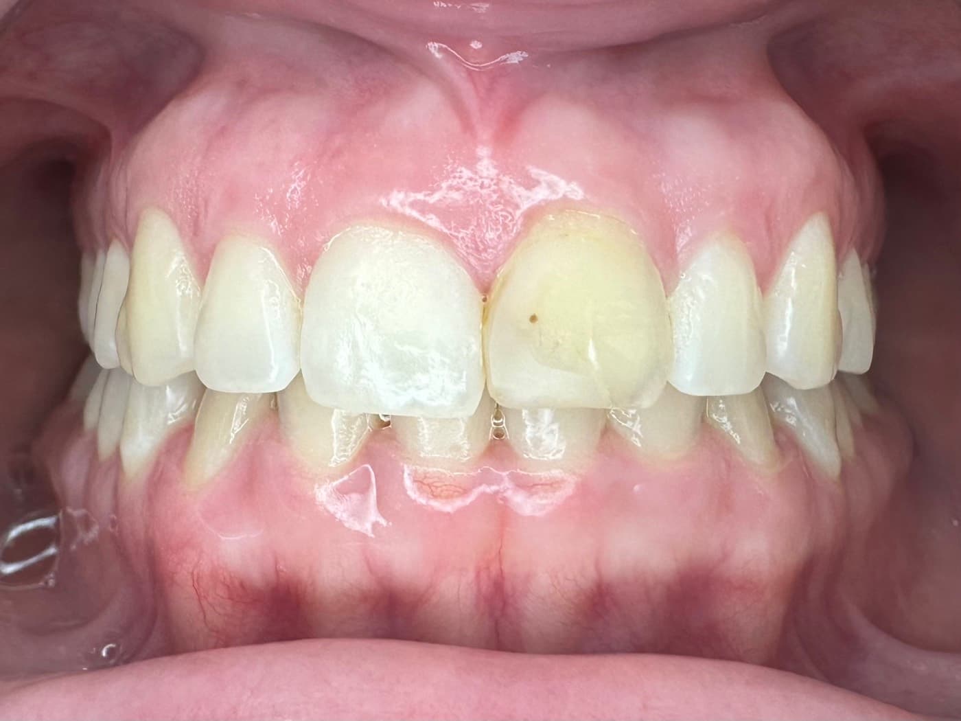 Case 05, before treatment