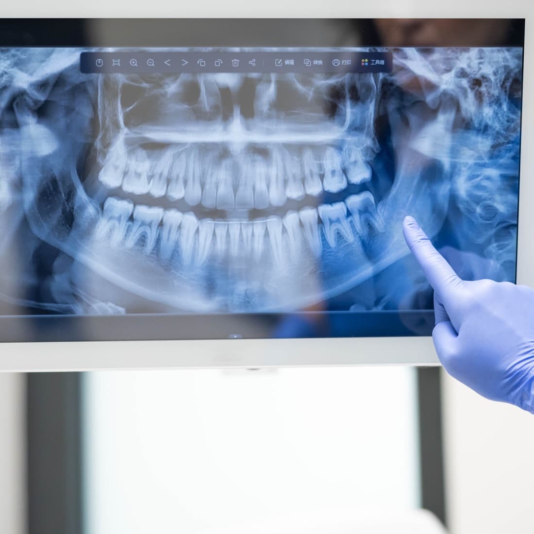 Panoramic dental X-ray displayed on a monitor